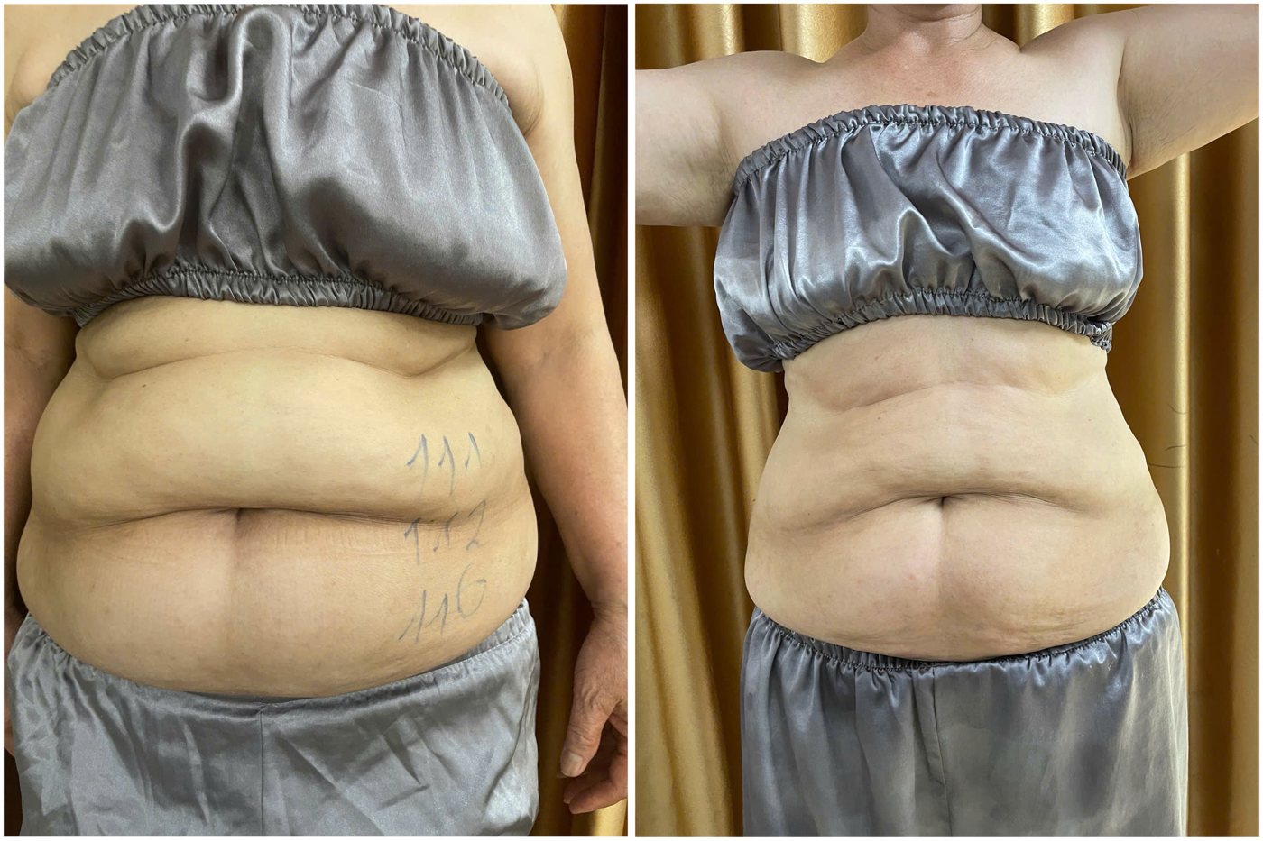 Ca thật giảm mỡ bụng trước và sau liệu trình bấm huyệt tại Mai Liên