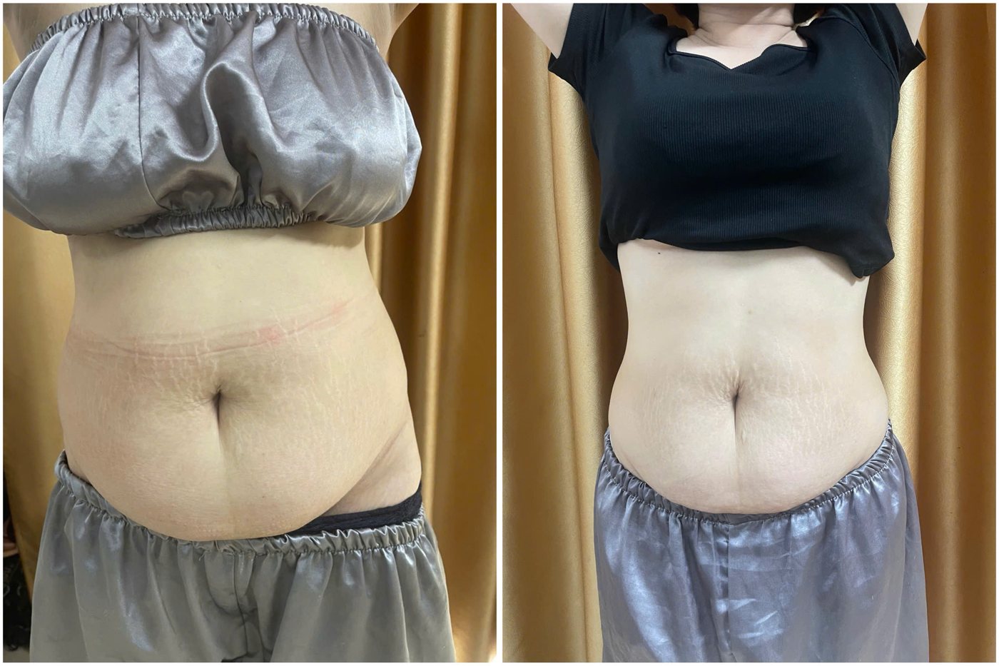 Ca thật giảm mỡ bụng sau sinh trước và sau tại Mai Liên