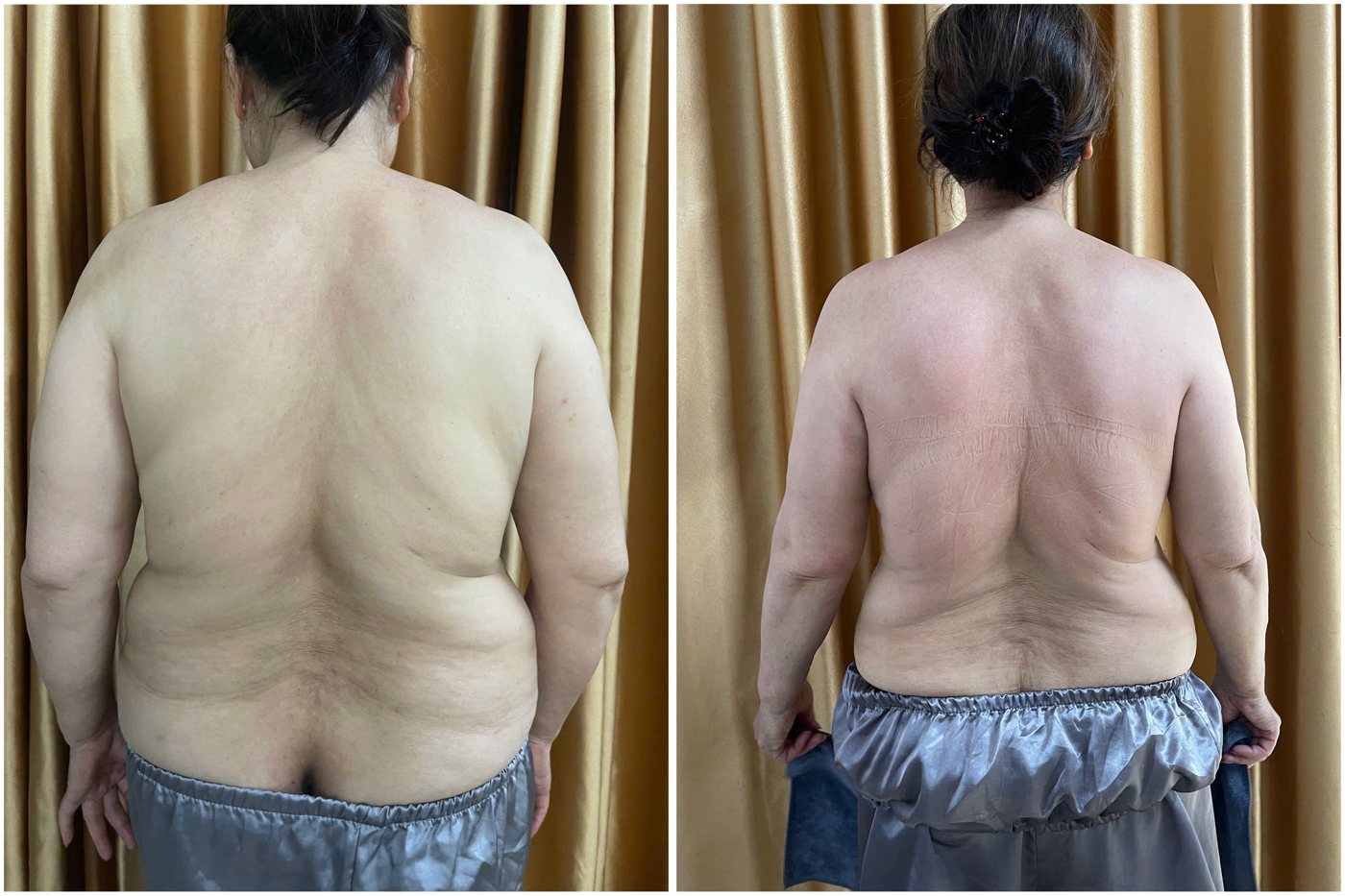 Ca thật giảm mỡ lưng trước và sau tại Mai Liên