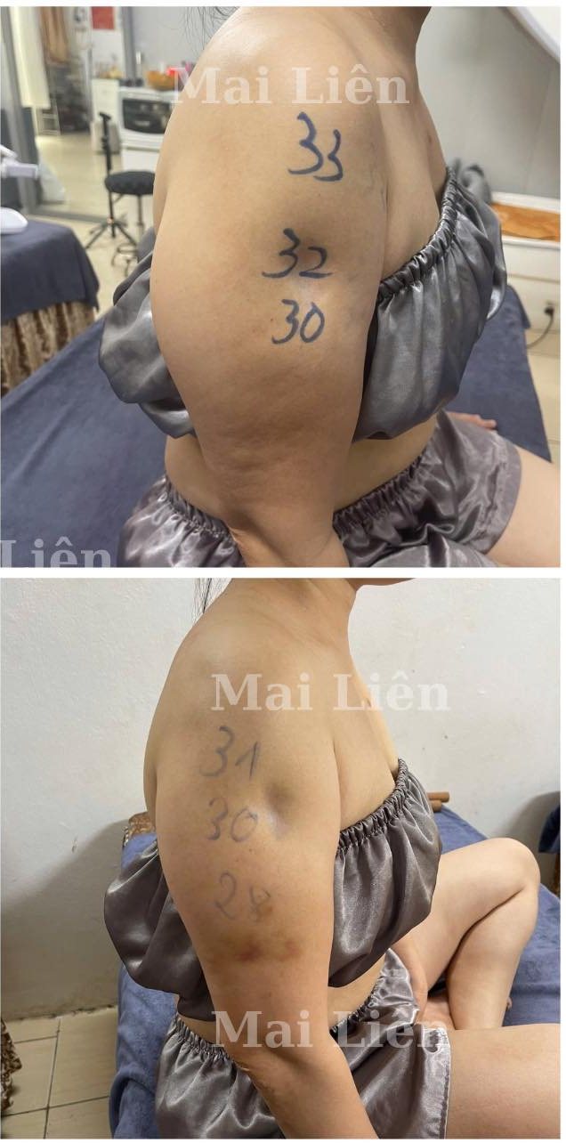 Ca thật giảm mỡ bắp tay trước và sau, có số đo vòng tay, tại Mai Liên