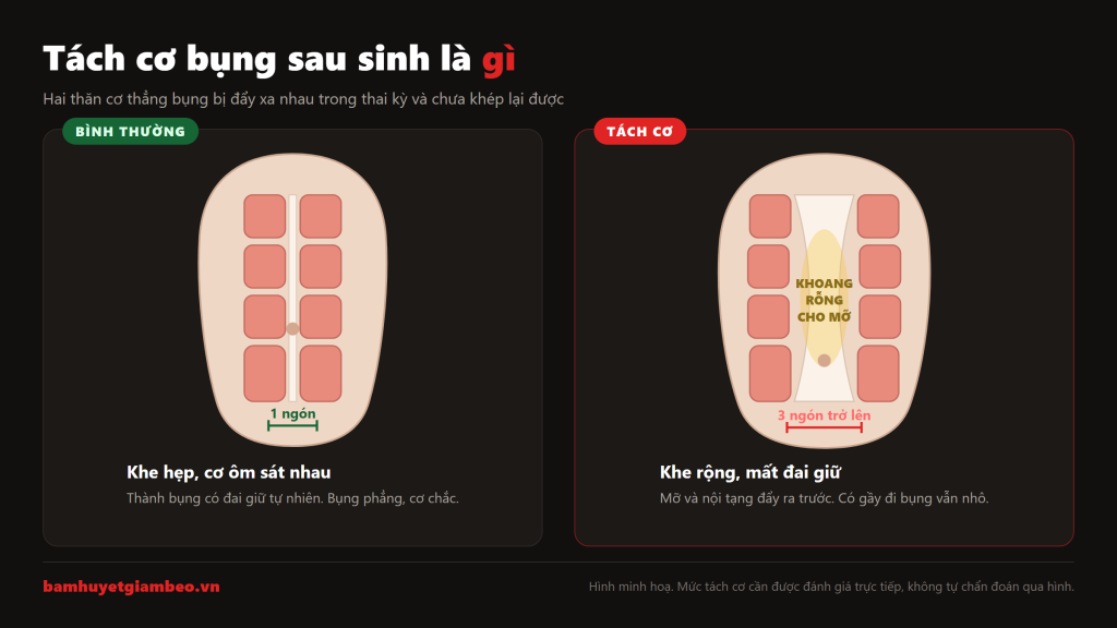 Sơ đồ tách cơ bụng sau sinh: so sánh cơ bụng bình thường và cơ bụng bị tách